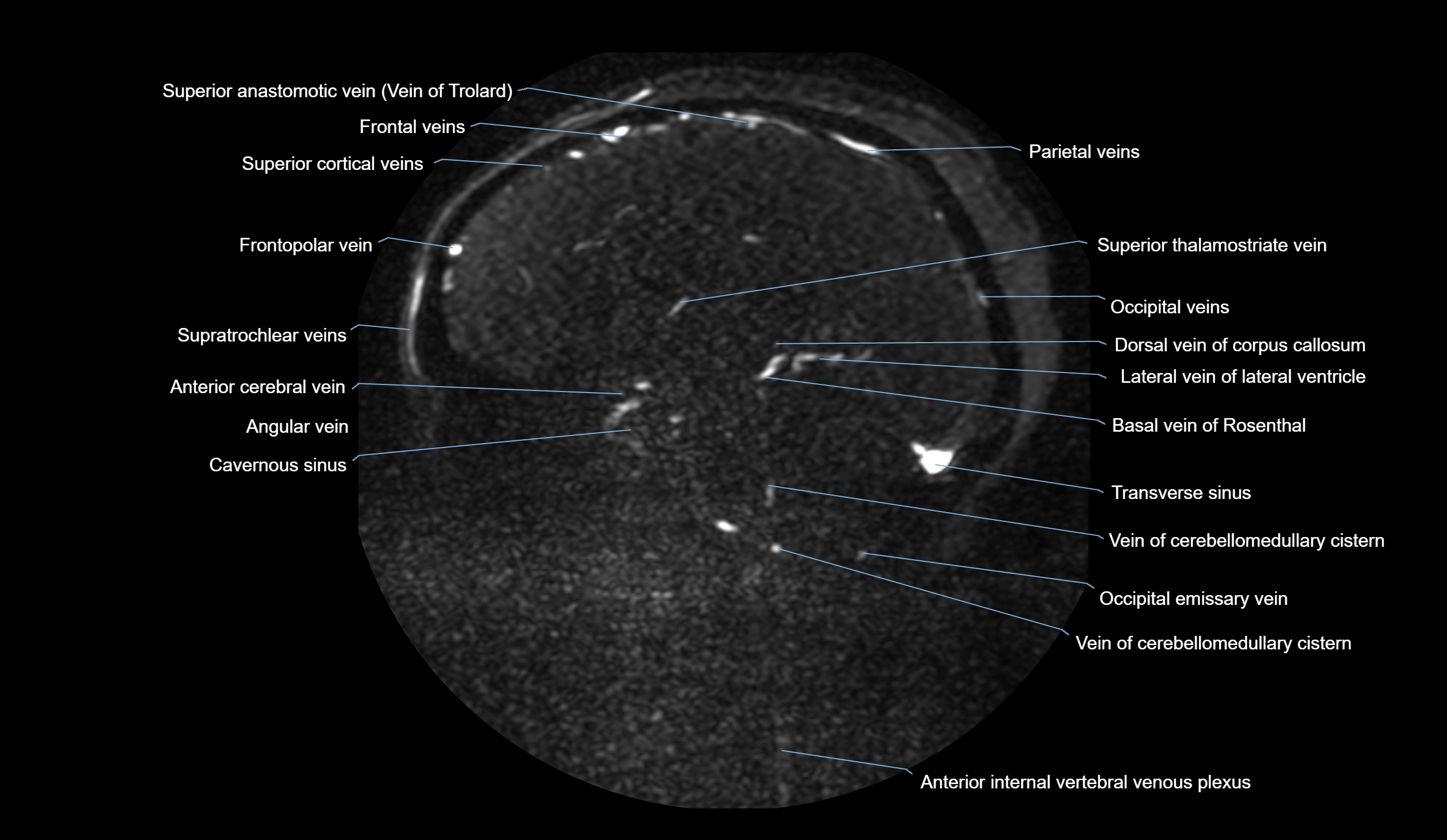 MRV brain sagittal anatomy 3T MRI images -img-01015-00039.webp